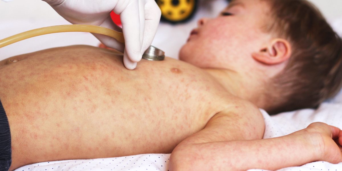 Doctor examines a child with a measles rash during a medical visit.