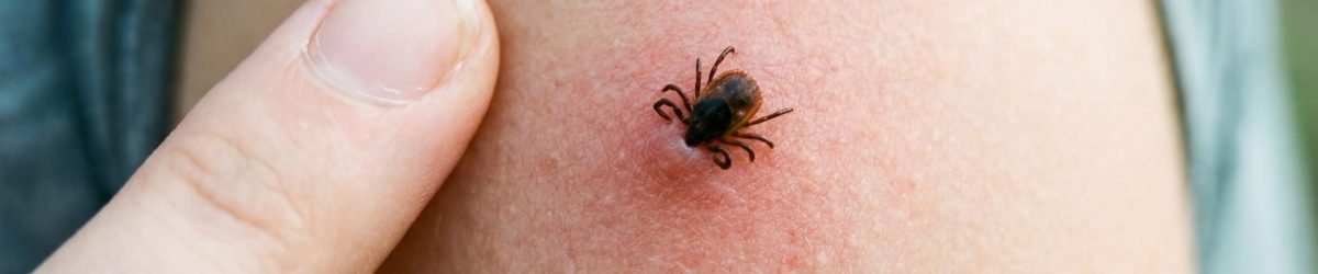 A,Close,Up,Shot,Of,A,Tick,Attached,To,Human